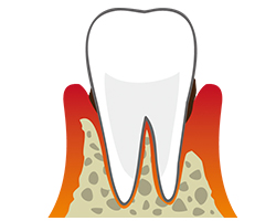 歯周病治療