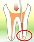 できるだけ歯を抜かずに残すための根管治療