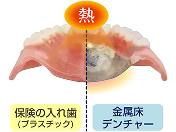 金属床デンチャーのここがすごい